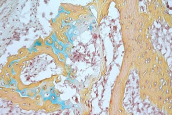 A small bone structure arising from the human skeletal stem cell contains cartilage (blue), bone marrow (brown) and bone (yellow).